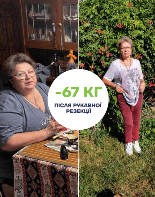 Maki med Історія успіху пані Тетяни після рукавної резекції шлунка before